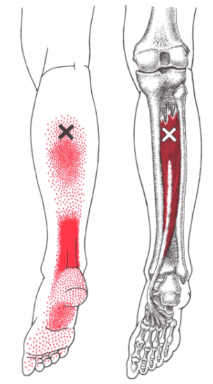 triggerpoints-tibialis-posterior