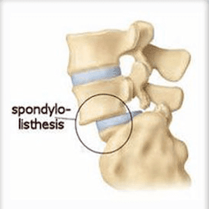 Spondylolisthesis En | Fysiotherapie4all