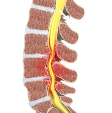 Spinaal kanaal stenose
