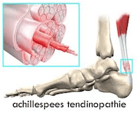 Achillespees Tendinopathie