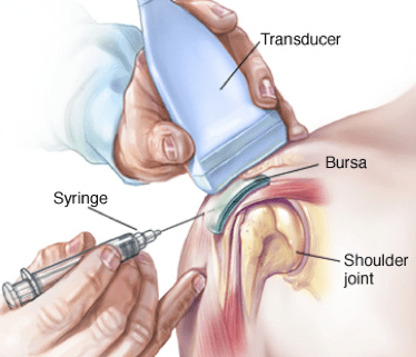slijmbeursontsteking-schouder-injectie