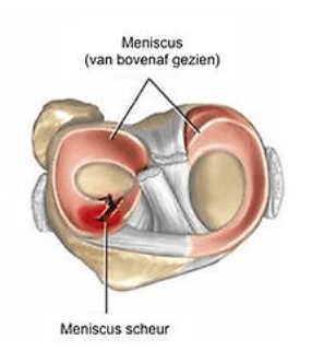 meniscus scheur